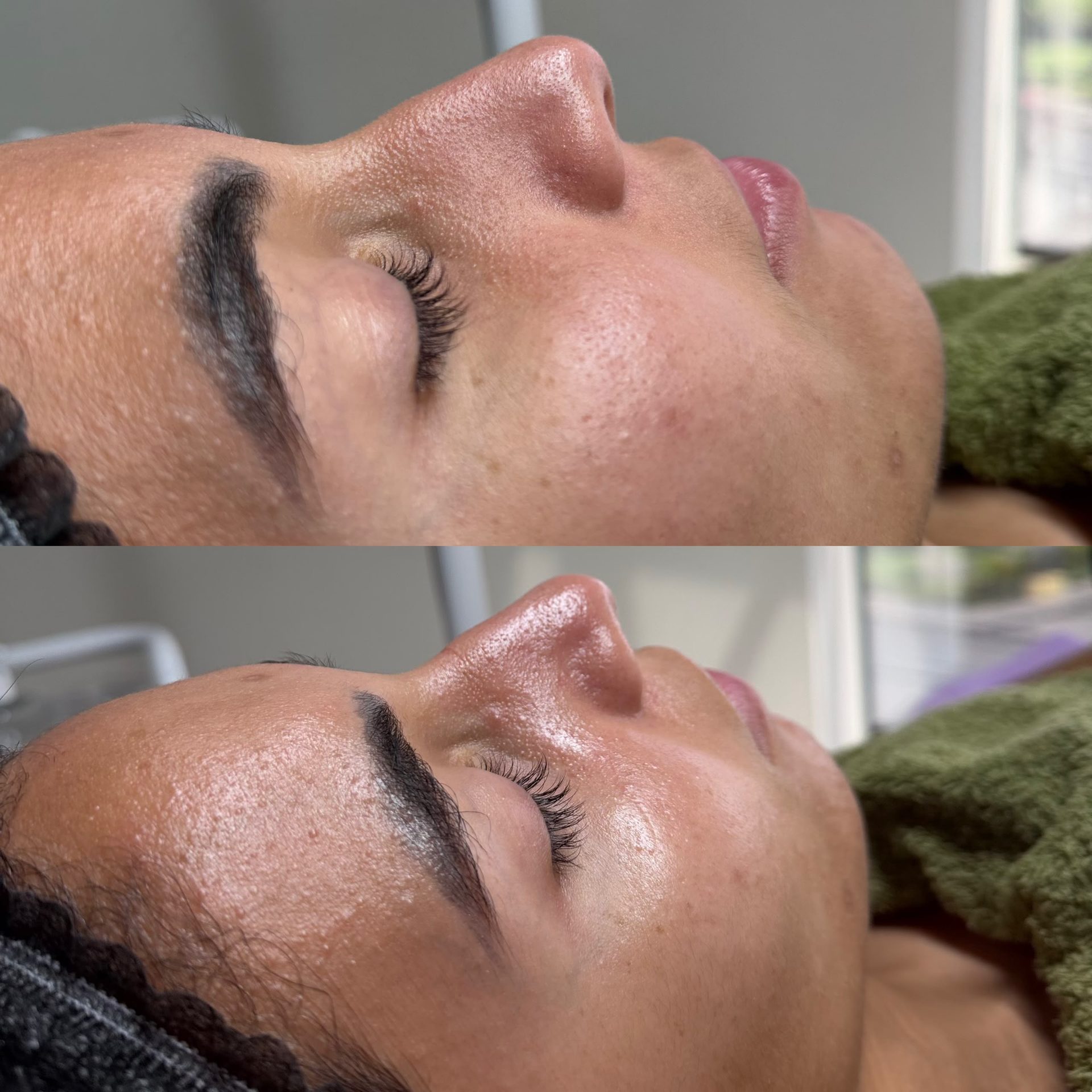Hydrafacial